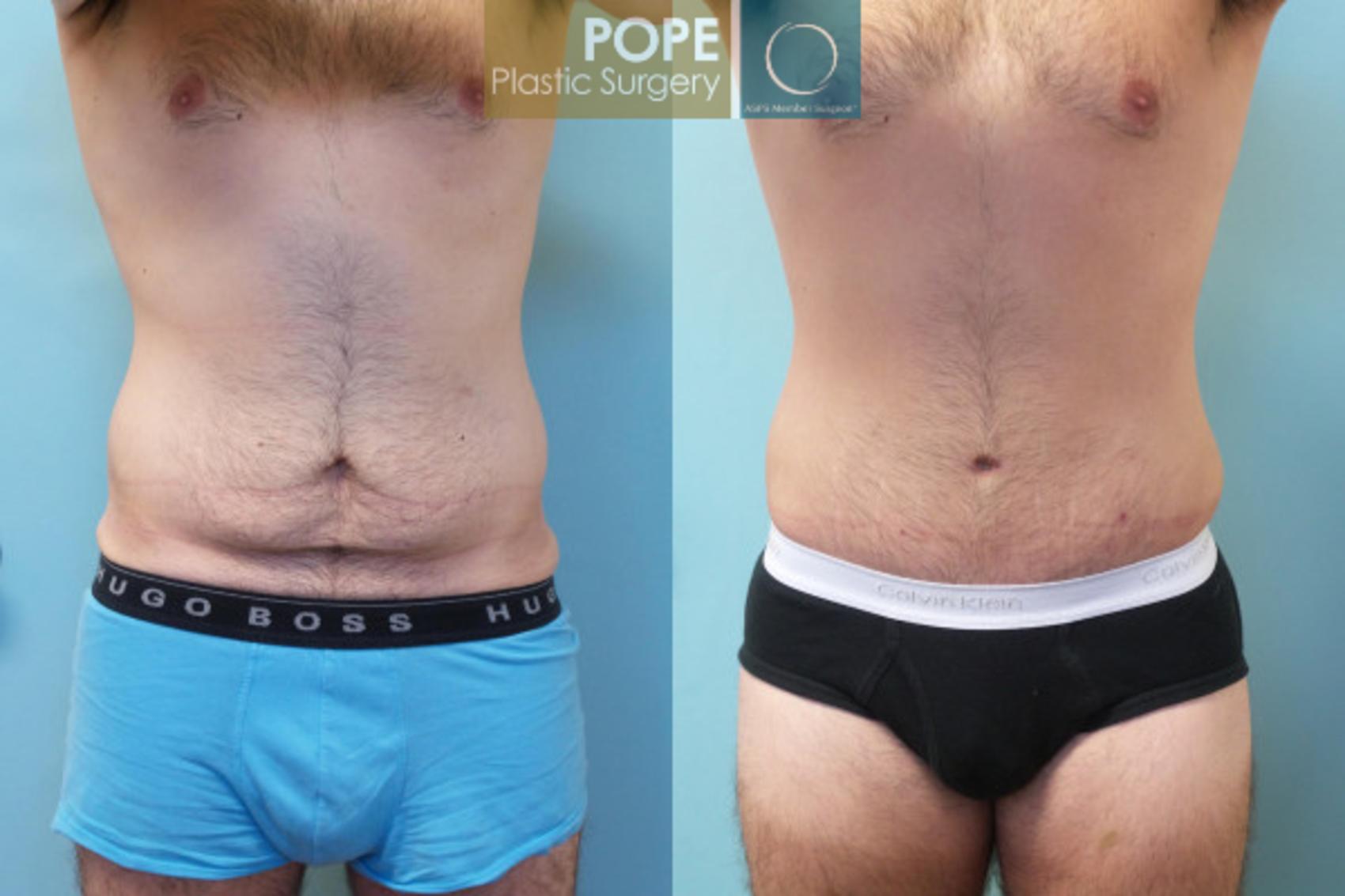 Before & After Body Procedures for Men Case 10 View #1 View in Orlando, FL