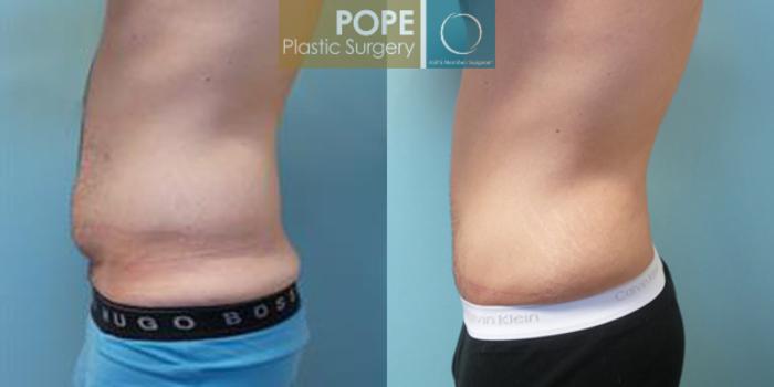 Before & After Tummy Tuck Case 10 View #2 View in Orlando, FL