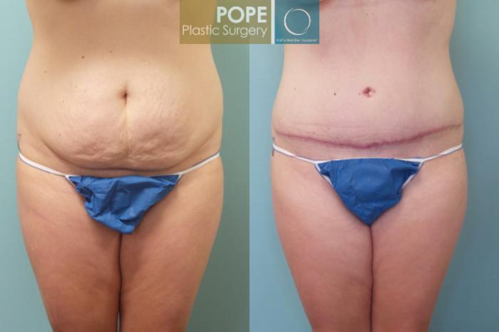 Before & After Tummy Tuck Case 107 View #1 View in Orlando, FL