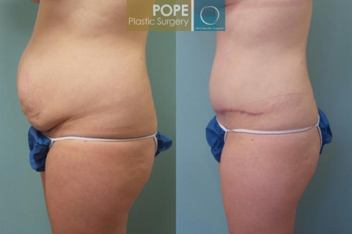Before & After Tummy Tuck Case 107 View #2 View in Orlando, FL