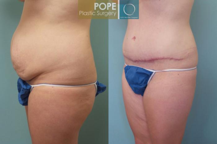 Before & After Tummy Tuck Case 107 View #3 View in Orlando, FL