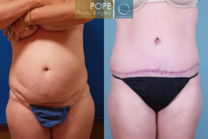 Before & After Tummy Tuck Case 108 View #1 View in Orlando, FL