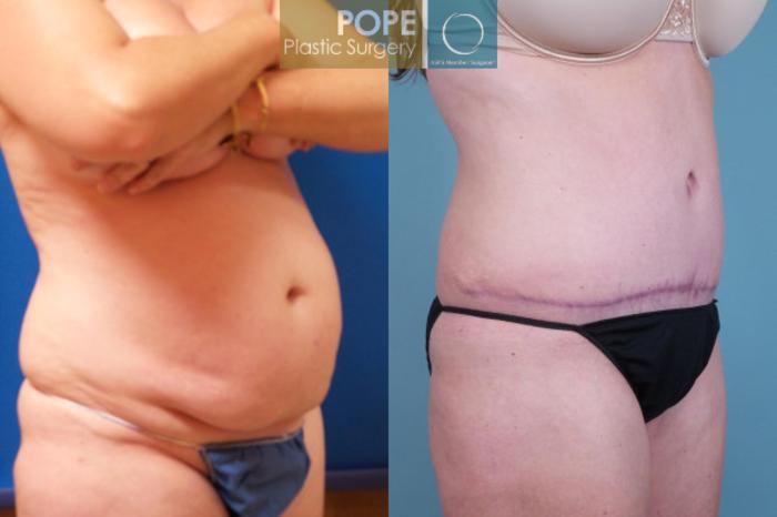 Before & After Tummy Tuck Case 108 View #2 View in Orlando, FL