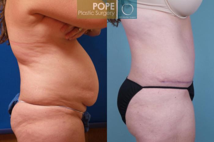 Before & After Tummy Tuck Case 108 View #3 View in Orlando, FL