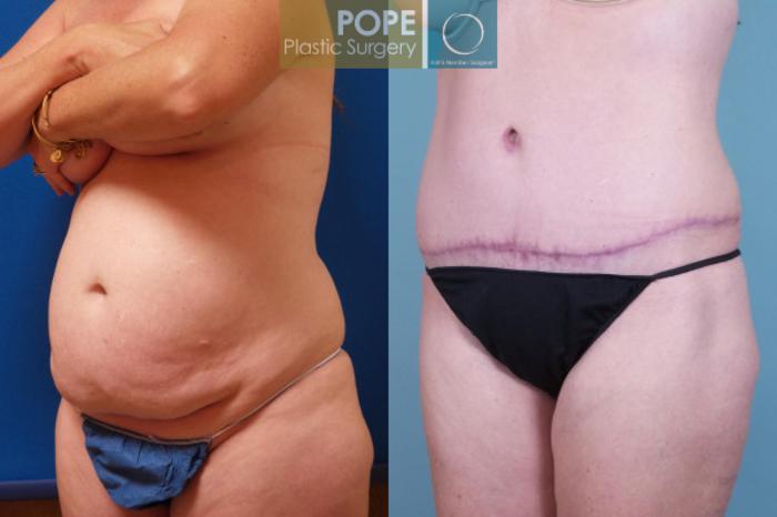 Before & After Tummy Tuck Case 108 View #4 View in Orlando, FL