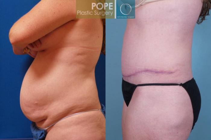 Before & After Tummy Tuck Case 108 View #5 View in Orlando, FL