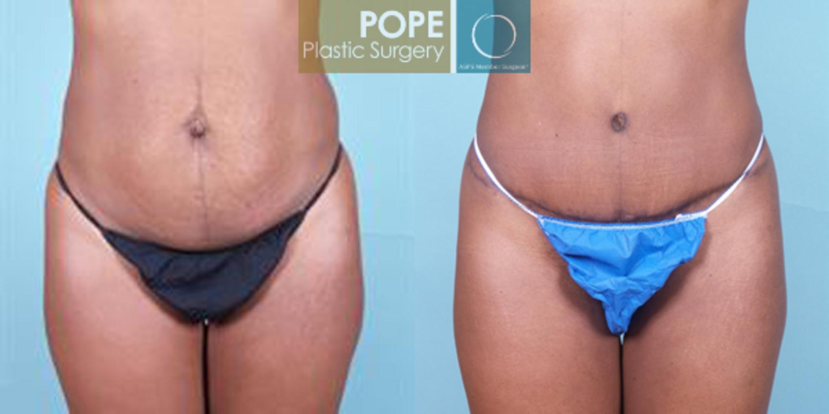 Before & After Tummy Tuck Case 11 View #1 View in Orlando, FL