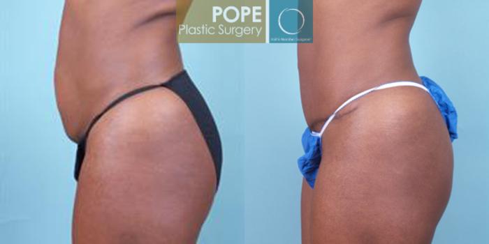 Before & After Tummy Tuck Case 11 View #2 View in Orlando, FL