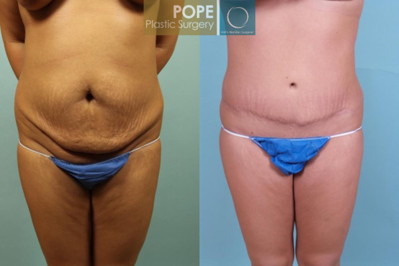 Before & After Tummy Tuck Case 12 View #1 View in Orlando, FL