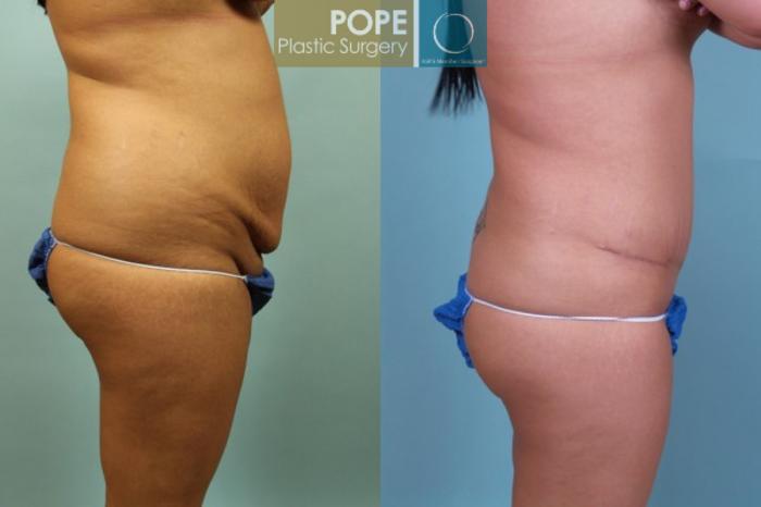 Before & After Tummy Tuck Case 12 View #2 View in Orlando, FL