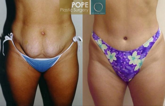 Before & After Tummy Tuck Case 13 View #1 View in Orlando, FL