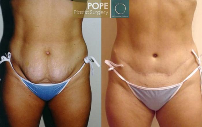 Before & After Tummy Tuck Case 13 View #2 View in Orlando, FL