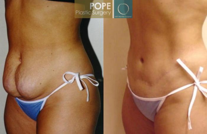 Before & After Tummy Tuck Case 13 View #3 View in Orlando, FL
