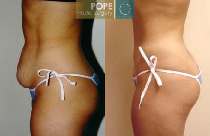 Before & After Tummy Tuck Case 13 View #4 View in Orlando, FL
