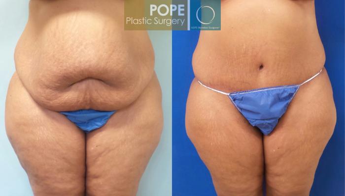 Before & After Tummy Tuck Case 184 View #1 View in Orlando, FL