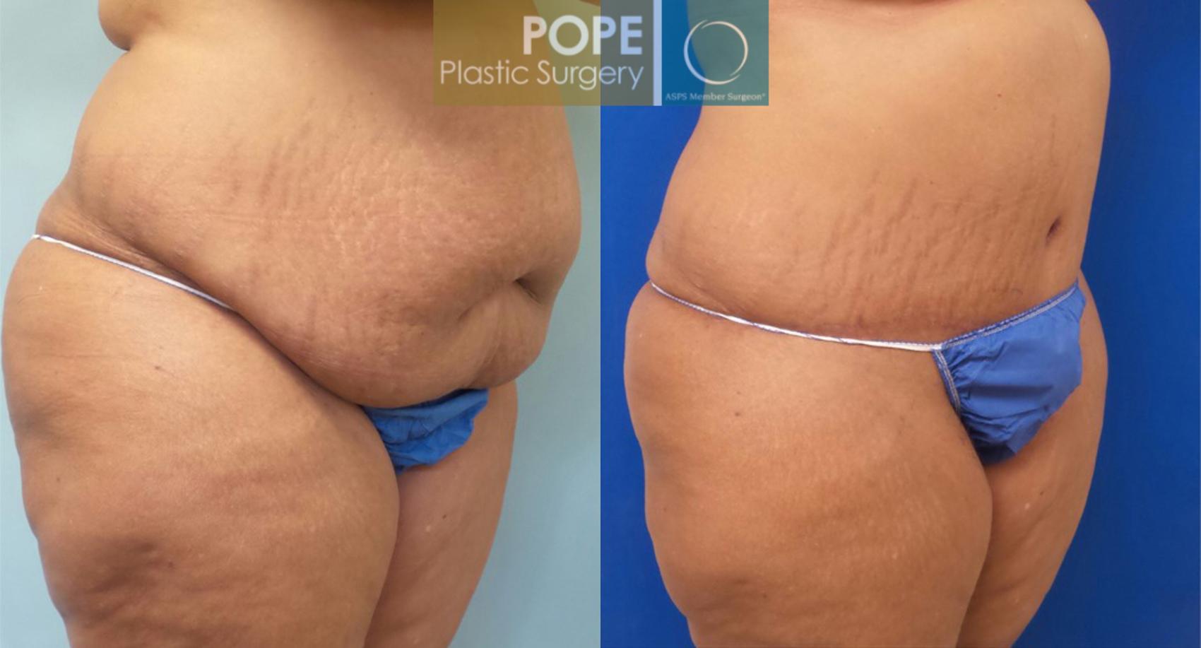 Before & After Tummy Tuck Case 184 View #2 View in Orlando, FL