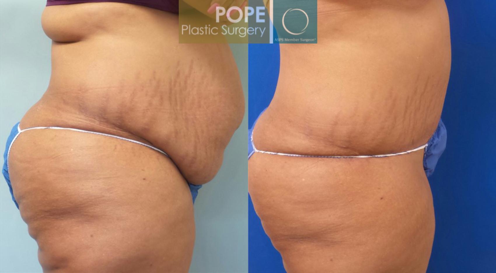 Before & After Tummy Tuck Case 184 View #3 View in Orlando, FL