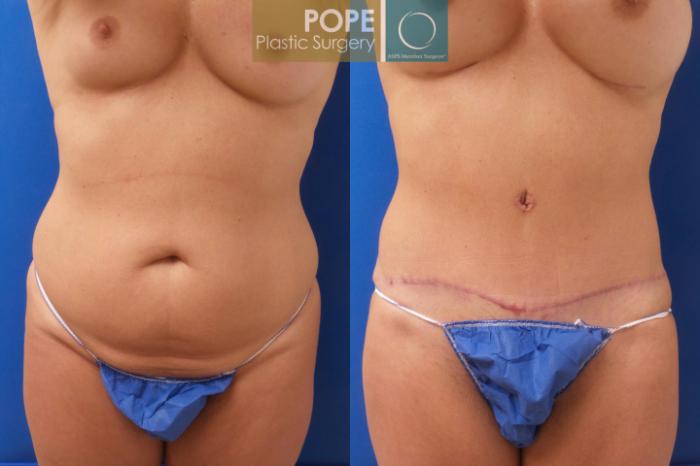 Before & After Tummy Tuck Case 192 Front View in Orlando, FL