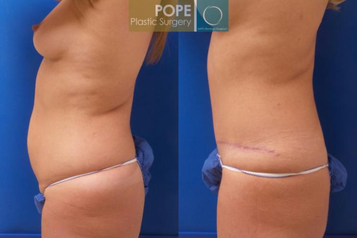 Before & After Tummy Tuck Case 192 Left Side View in Orlando, FL