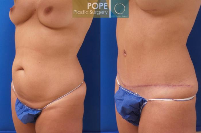 Before & After Tummy Tuck Case 192 Right Oblique View in Orlando, FL