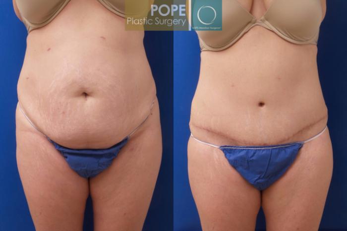 Before & After Tummy Tuck Case 196 Front View in Orlando, FL