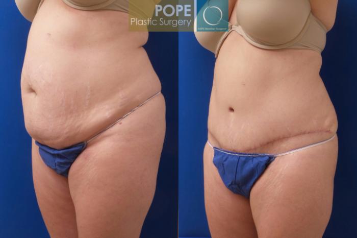 Before & After Tummy Tuck Case 196 Left Oblique View in Orlando, FL