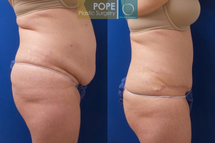 Before & After Tummy Tuck Case 196 Left Side View in Orlando, FL