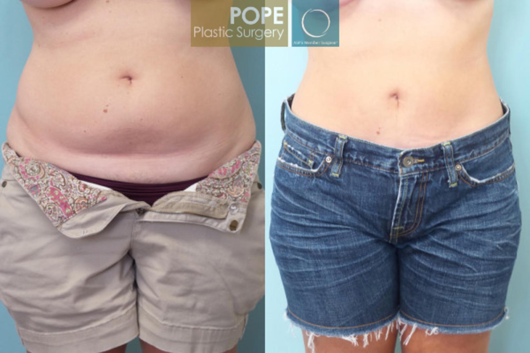 Before & After Tummy Tuck Case 54 View #1 View in Orlando, FL