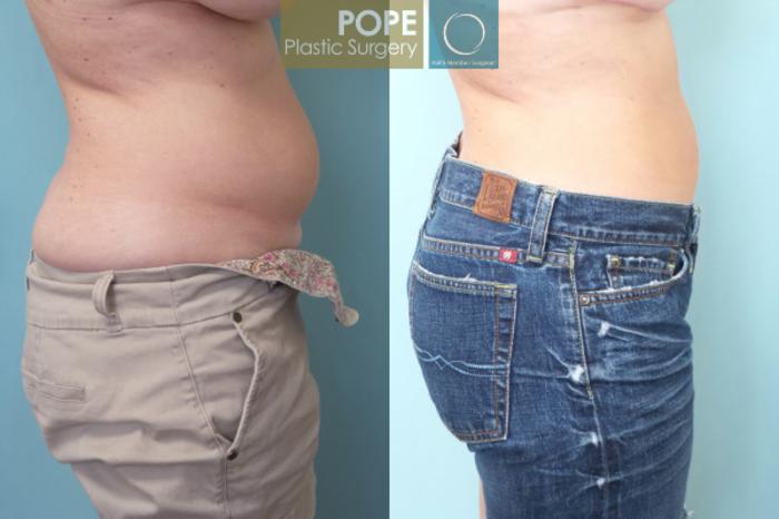 Before & After Tummy Tuck Case 54 View #2 View in Orlando, FL
