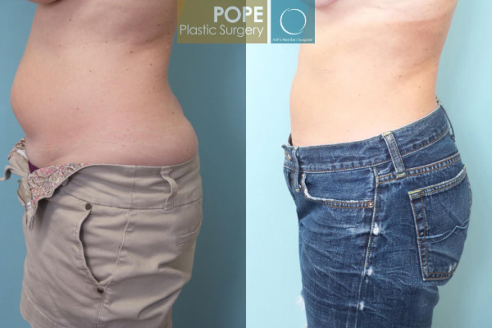 Tummy Tuck Before & After Photos Patient 54 | Orlando, FL | Pope