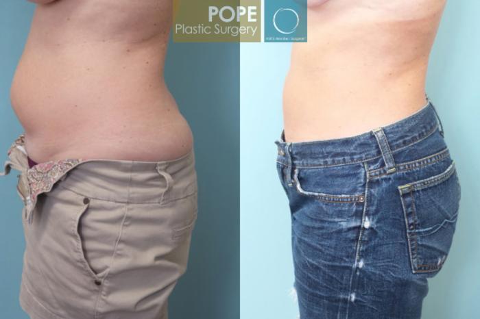 Before & After Tummy Tuck Case 54 View #3 View in Orlando, FL