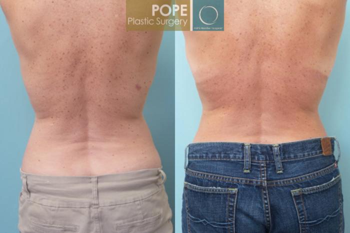 Before & After Tummy Tuck Case 54 View #4 View in Orlando, FL