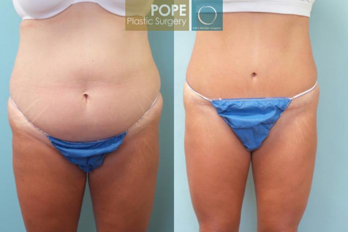 Before & After Tummy Tuck Case 7 View #1 View in Orlando, FL