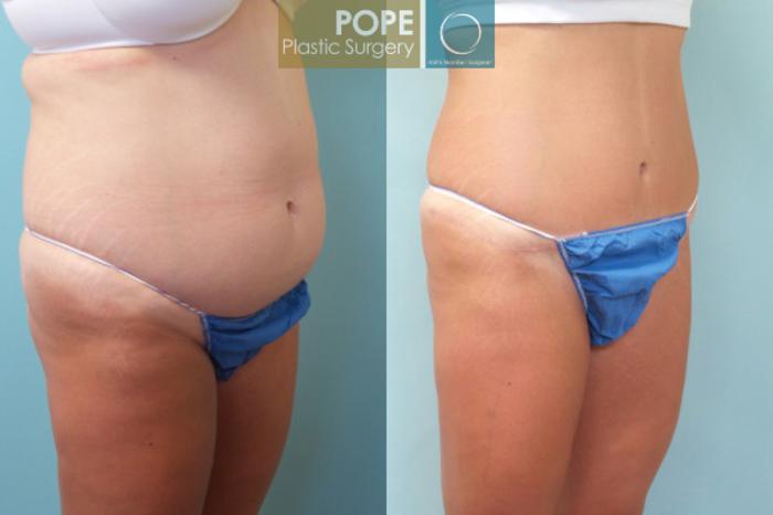 Before & After Tummy Tuck Case 7 View #2 View in Orlando, FL