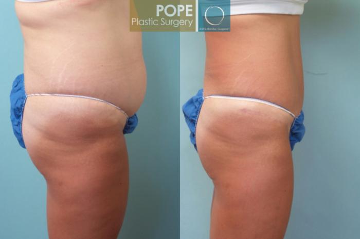 Before & After Tummy Tuck Case 7 View #3 View in Orlando, FL