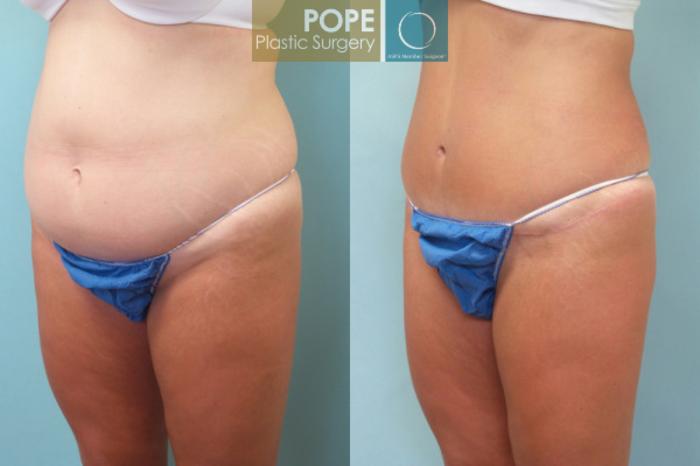 Before & After Tummy Tuck Case 7 View #4 View in Orlando, FL