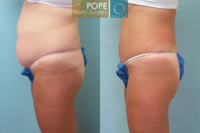 Before & After Tummy Tuck Case 7 View #5 View in Orlando, FL