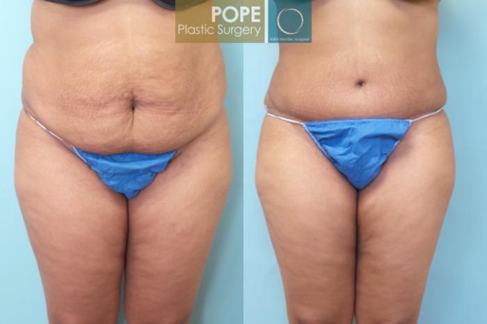 Before & After Tummy Tuck Case 8 View #1 View in Orlando, FL