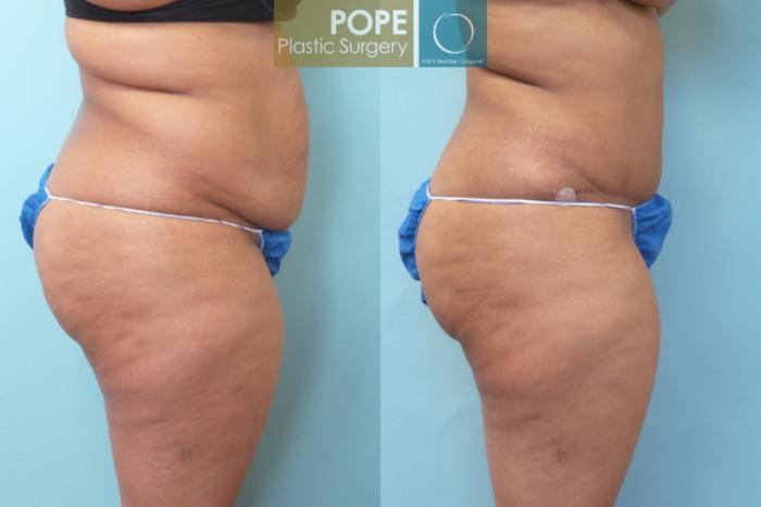 Before & After Tummy Tuck Case 8 View #2 View in Orlando, FL
