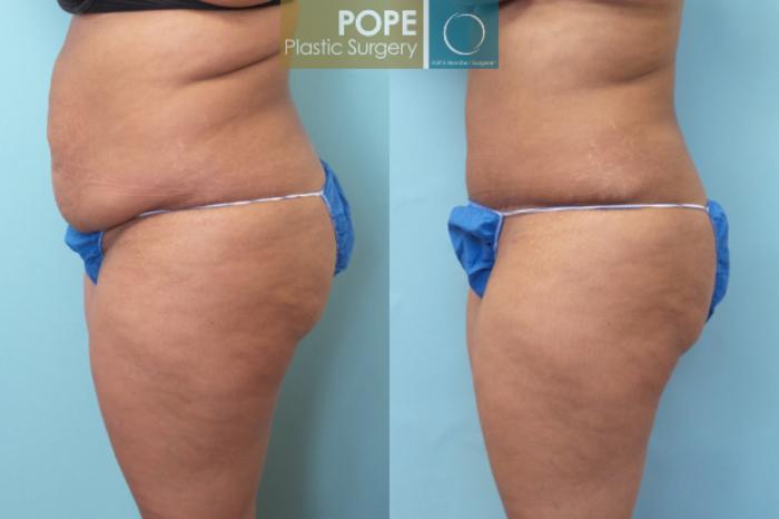 Before & After Tummy Tuck Case 8 View #3 View in Orlando, FL